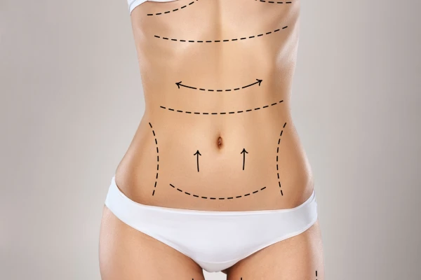 abdominoplastía en guadalajara mexico abdominoplastía en guadalajara mexico